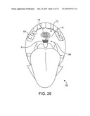 AIRWAY IMPLANT AND METHODS OF MAKING AND USING diagram and image