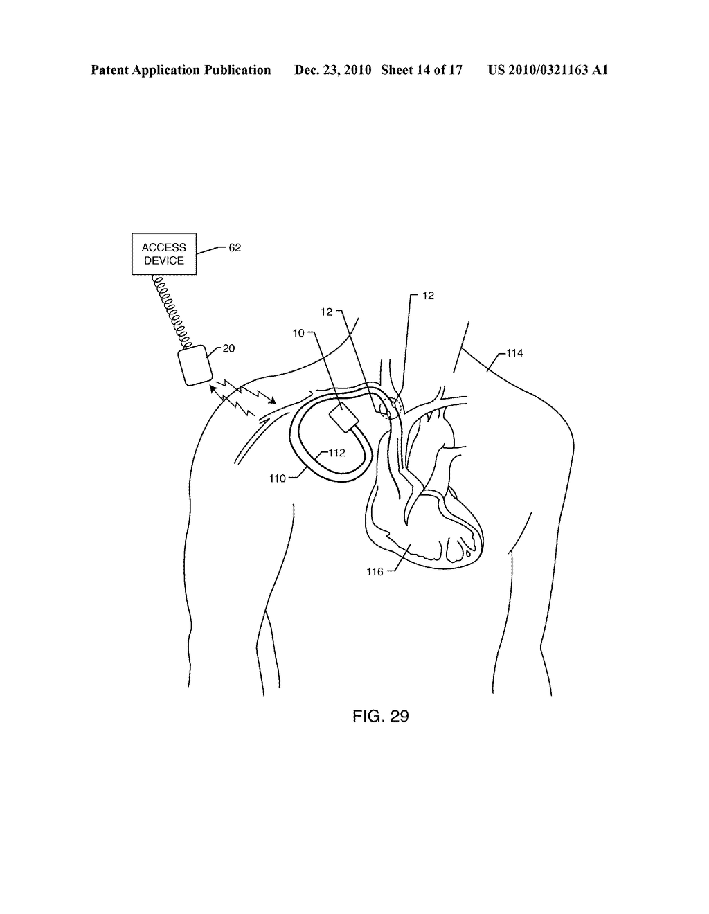 RFID DETECTION AND IDENTIFICATION SYSTEM FOR IMPLANTABLE MEDICAL LEAD SYSTEMS - diagram, schematic, and image 15