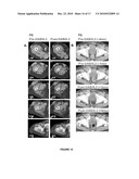 T CELL DEPLETING COMPOSITIONS USEFUL FOR TREATING CANCER diagram and image