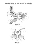 DEVICE AND METHOD FOR IMPROVING HEARING diagram and image