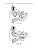 DEVICE AND METHOD FOR IMPROVING HEARING diagram and image