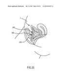 Insertion Device and Method for Delivery of a Mesh Carrier diagram and image