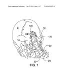 MINIMAL ACCESS OCCIPITAL PLATE diagram and image