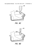 DEVICES, SYSTEMS AND METHODS FOR PREVENTING AND TREATING SENSATION LOSS diagram and image