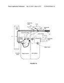 ATRIAL DEFIBRILLATION USING AN IMPLANTABLE DEFIBRILLATION SYSTEM diagram and image