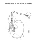 METHODOLOGY AND APPARATUS TO TERMINATE ABANDONED ACTIVE IMPLANTABLE MEDICAL DEVICE LEADS diagram and image