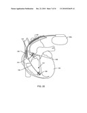 METHODOLOGY AND APPARATUS TO TERMINATE ABANDONED ACTIVE IMPLANTABLE MEDICAL DEVICE LEADS diagram and image