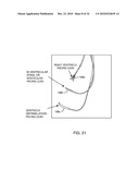 METHODOLOGY AND APPARATUS TO TERMINATE ABANDONED ACTIVE IMPLANTABLE MEDICAL DEVICE LEADS diagram and image