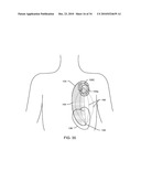 METHODOLOGY AND APPARATUS TO TERMINATE ABANDONED ACTIVE IMPLANTABLE MEDICAL DEVICE LEADS diagram and image