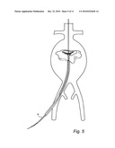 Device and method for treating ruptured aneurysms diagram and image