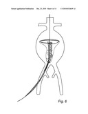 Device and method for treating ruptured aneurysms diagram and image