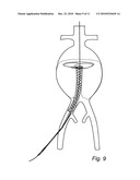 Device and method for treating ruptured aneurysms diagram and image