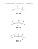 Accommodating Intraocular Lens Having Peripherally Actuated Deflectable Surface and Method diagram and image