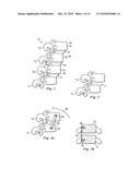 Spinal Prosthetic Joints diagram and image