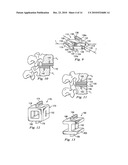 Spinal Prosthetic Joints diagram and image