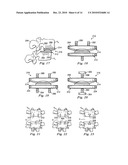 Spinal Prosthetic Joints diagram and image