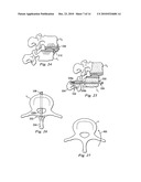 Spinal Prosthetic Joints diagram and image