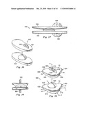 Spinal Prosthetic Joints diagram and image