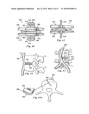 Spinal Prosthetic Joints diagram and image