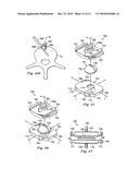 Spinal Prosthetic Joints diagram and image