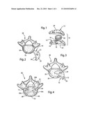 Intervertebral Implant Component With Three Points of Contact diagram and image