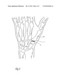 TRAPEZIOMETACARPAL JOINT IMPLANT AND ASSOCIATED METHODS diagram and image