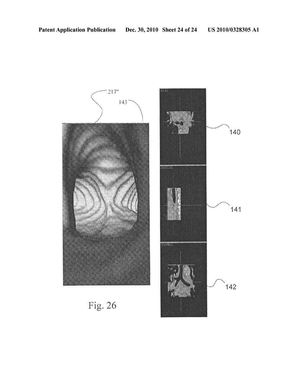 Method and System for Producing Interactive, Three-Dimensional Renderings of Selected Body Organs Having Hollow Lumens to Enable Simulated Movement Through the Lumen - diagram, schematic, and image 25