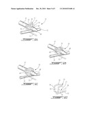 SURGICALLY IMPLANTABLE URETHRA PRESSURE CONTROL VALVE diagram and image