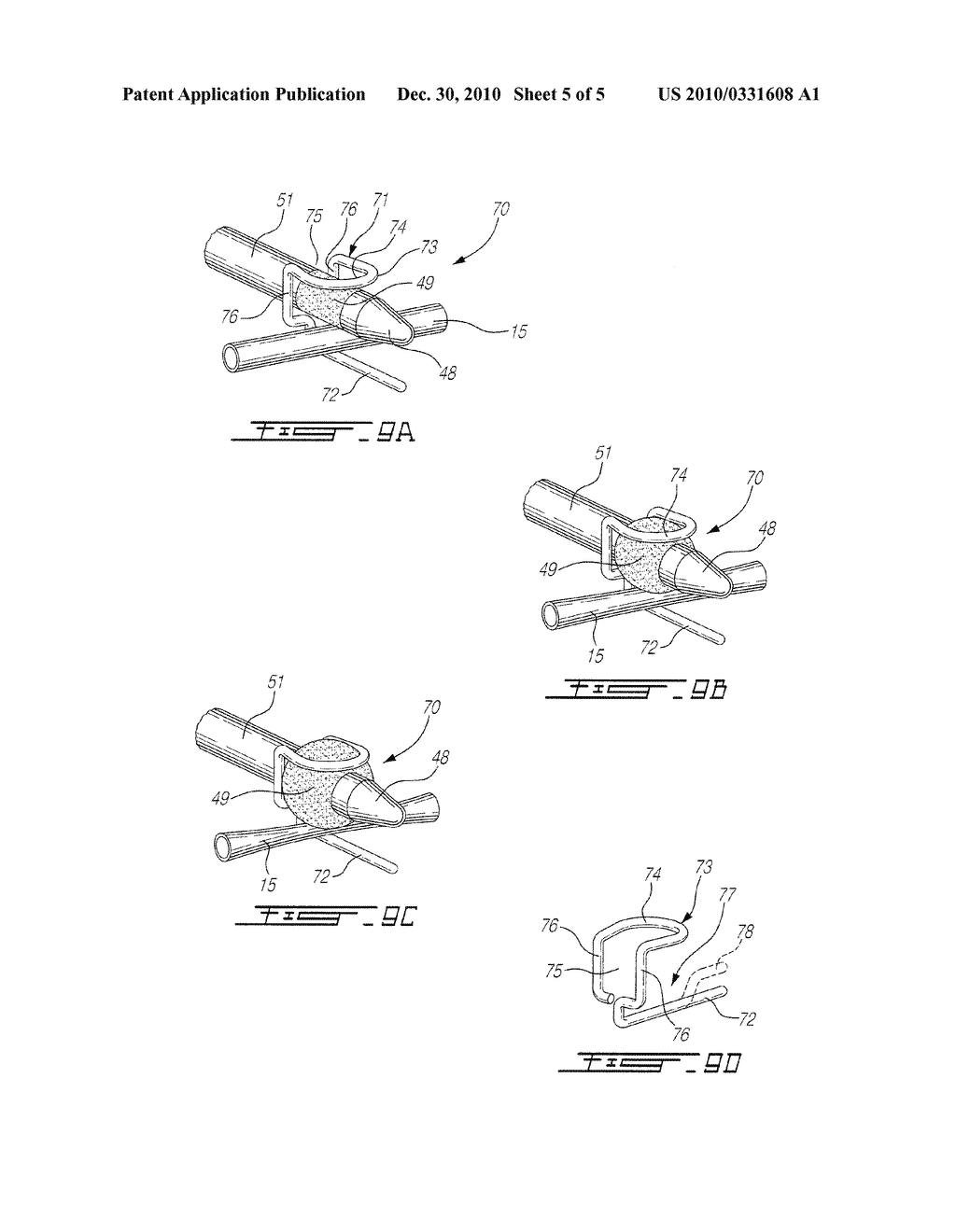 SURGICALLY IMPLANTABLE URETHRA PRESSURE CONTROL VALVE - diagram, schematic, and image 06