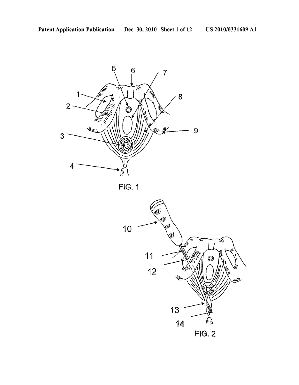 SYSTEM AND METHOD FOR TREATMENT OF ANAL INCONTINENCE AND PELVIC ORGAN PROLAPSE - diagram, schematic, and image 02