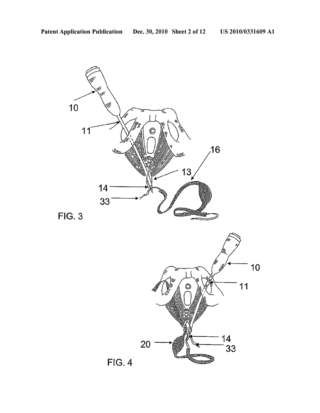 SYSTEM AND METHOD FOR TREATMENT OF ANAL INCONTINENCE AND PELVIC ORGAN PROLAPSE - diagram, schematic, and image 03