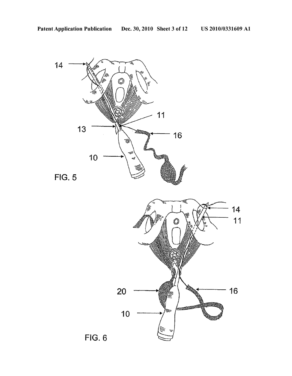 SYSTEM AND METHOD FOR TREATMENT OF ANAL INCONTINENCE AND PELVIC ORGAN PROLAPSE - diagram, schematic, and image 04