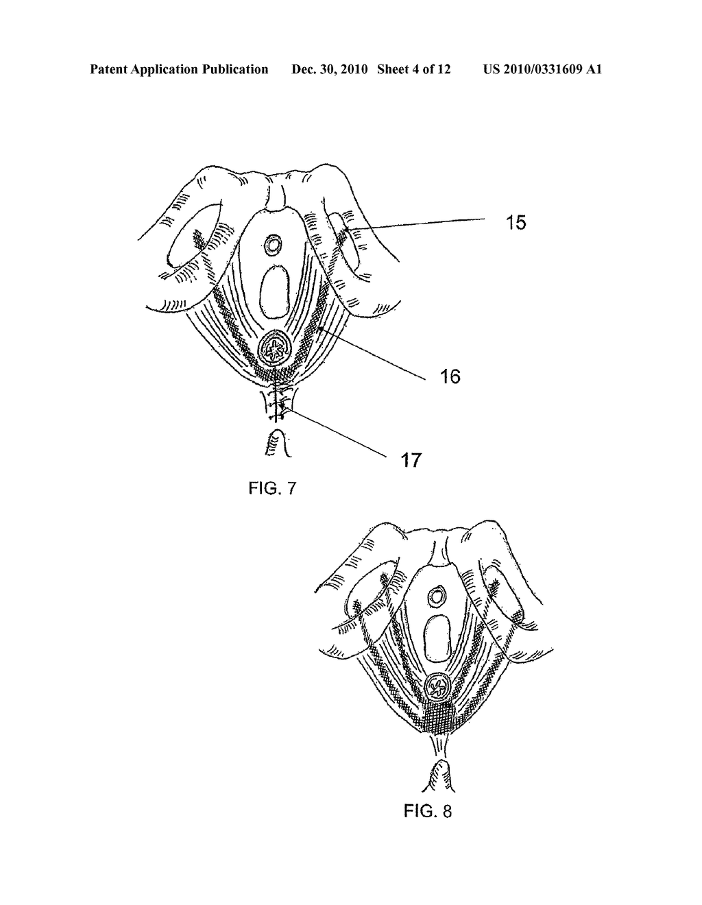 SYSTEM AND METHOD FOR TREATMENT OF ANAL INCONTINENCE AND PELVIC ORGAN PROLAPSE - diagram, schematic, and image 05