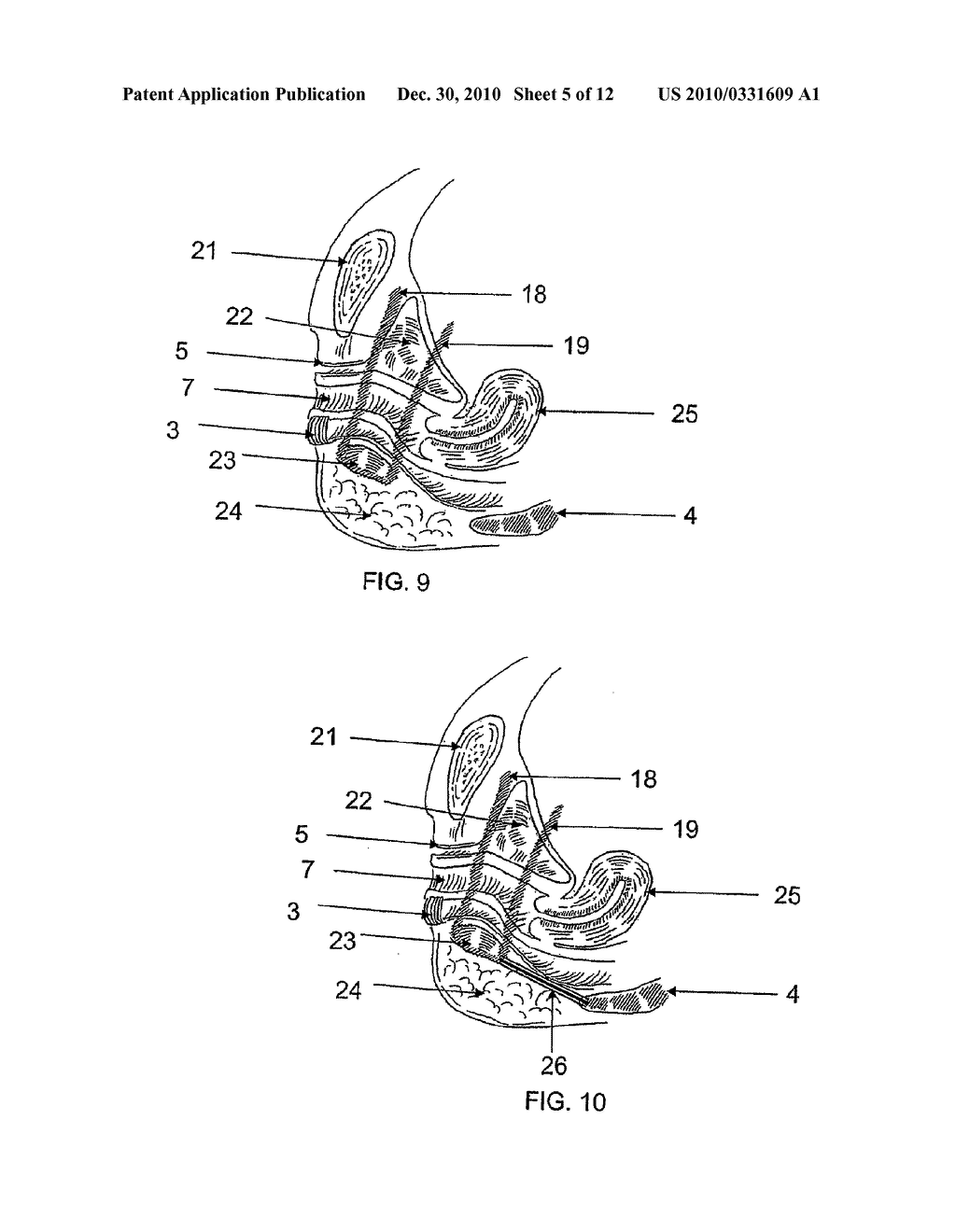 SYSTEM AND METHOD FOR TREATMENT OF ANAL INCONTINENCE AND PELVIC ORGAN PROLAPSE - diagram, schematic, and image 06