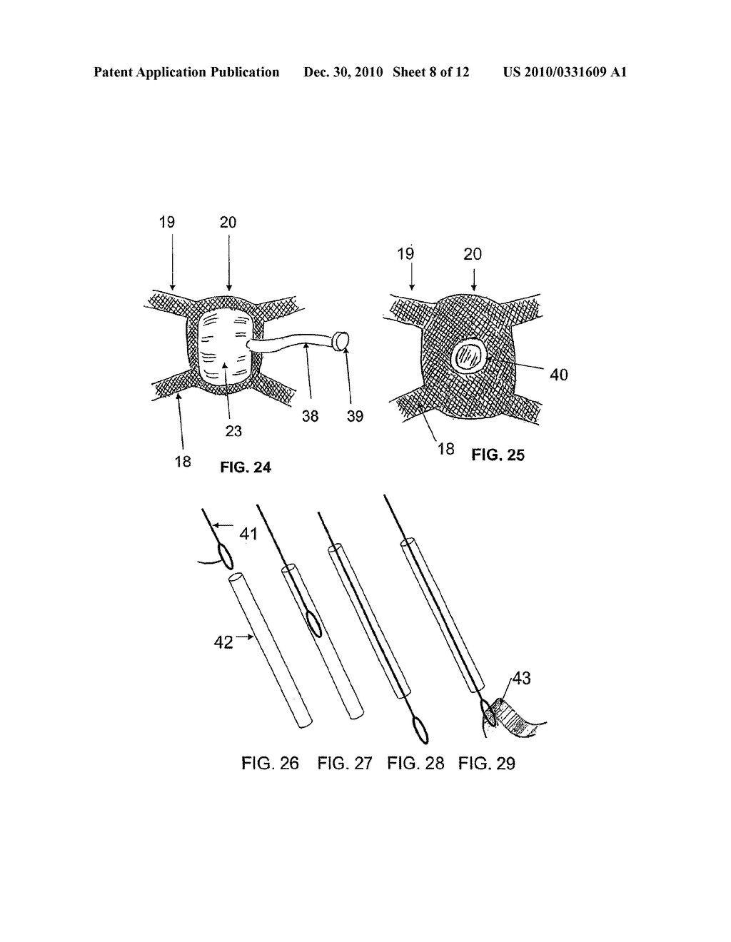 SYSTEM AND METHOD FOR TREATMENT OF ANAL INCONTINENCE AND PELVIC ORGAN PROLAPSE - diagram, schematic, and image 09