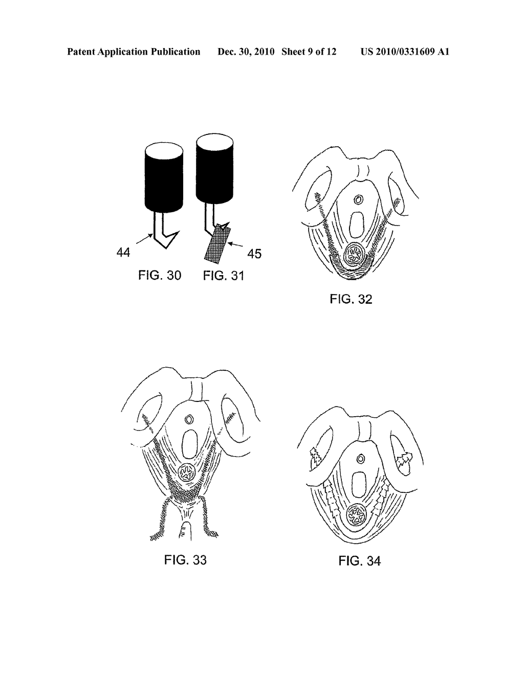 SYSTEM AND METHOD FOR TREATMENT OF ANAL INCONTINENCE AND PELVIC ORGAN PROLAPSE - diagram, schematic, and image 10