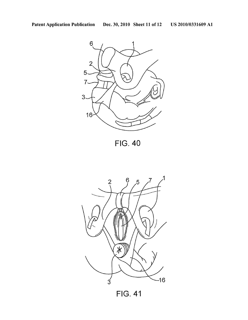 SYSTEM AND METHOD FOR TREATMENT OF ANAL INCONTINENCE AND PELVIC ORGAN PROLAPSE - diagram, schematic, and image 12