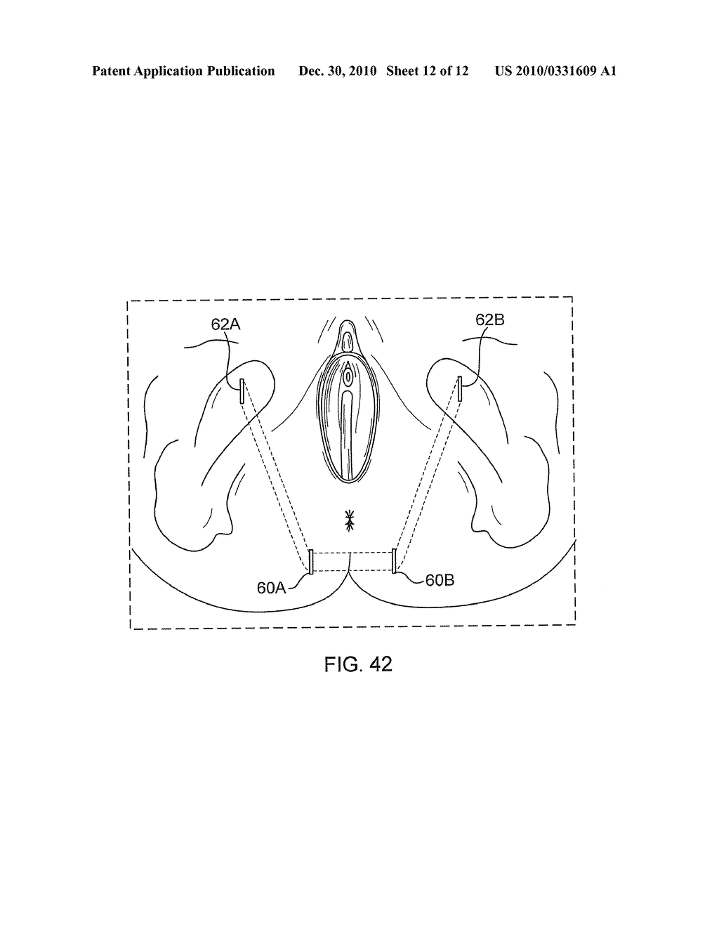 SYSTEM AND METHOD FOR TREATMENT OF ANAL INCONTINENCE AND PELVIC ORGAN PROLAPSE - diagram, schematic, and image 13