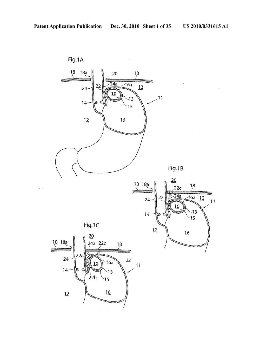 METHOD AND INSTRUMENTS FOR TREATING GERD - diagram, schematic, and image 02