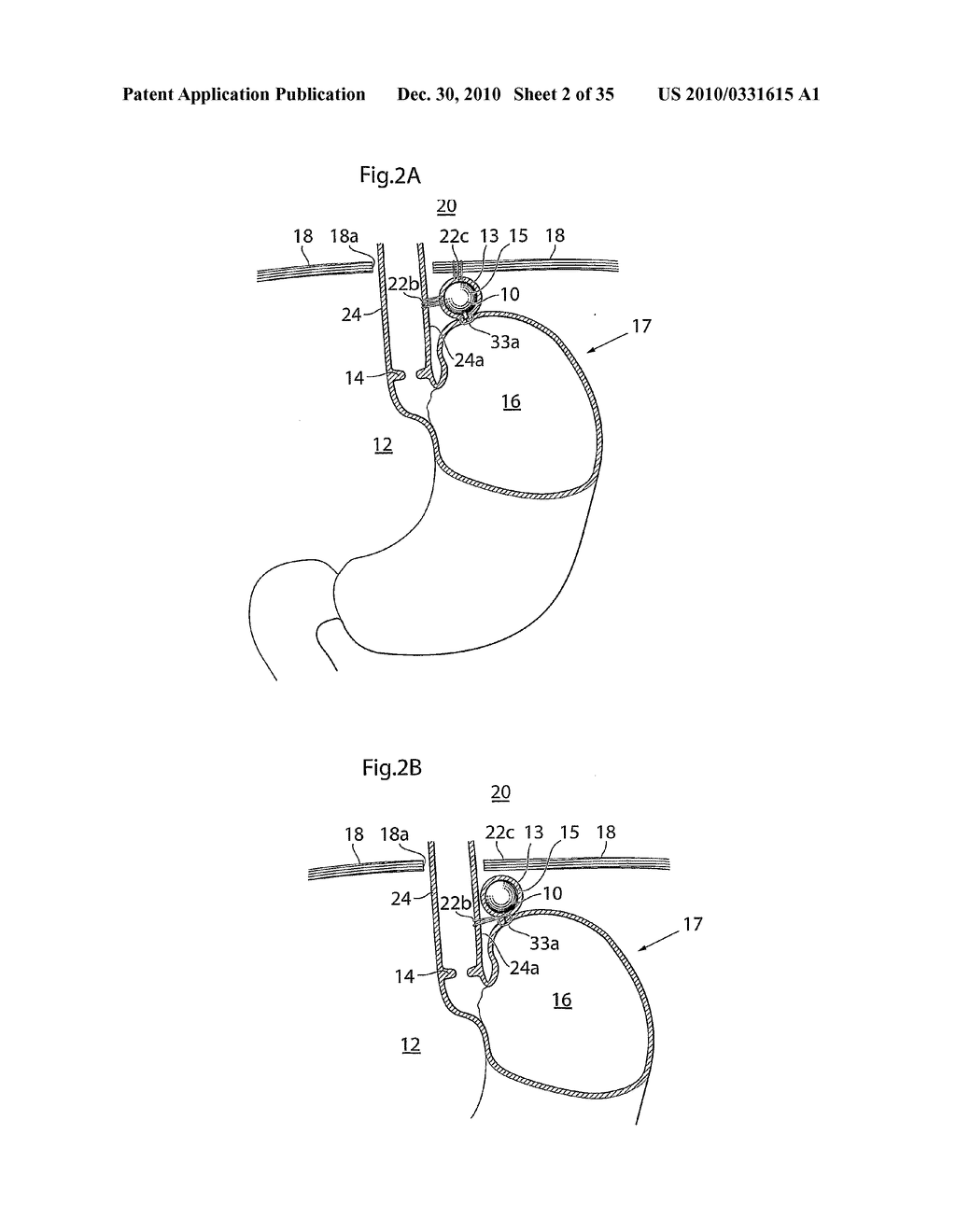 METHOD AND INSTRUMENTS FOR TREATING GERD - diagram, schematic, and image 03