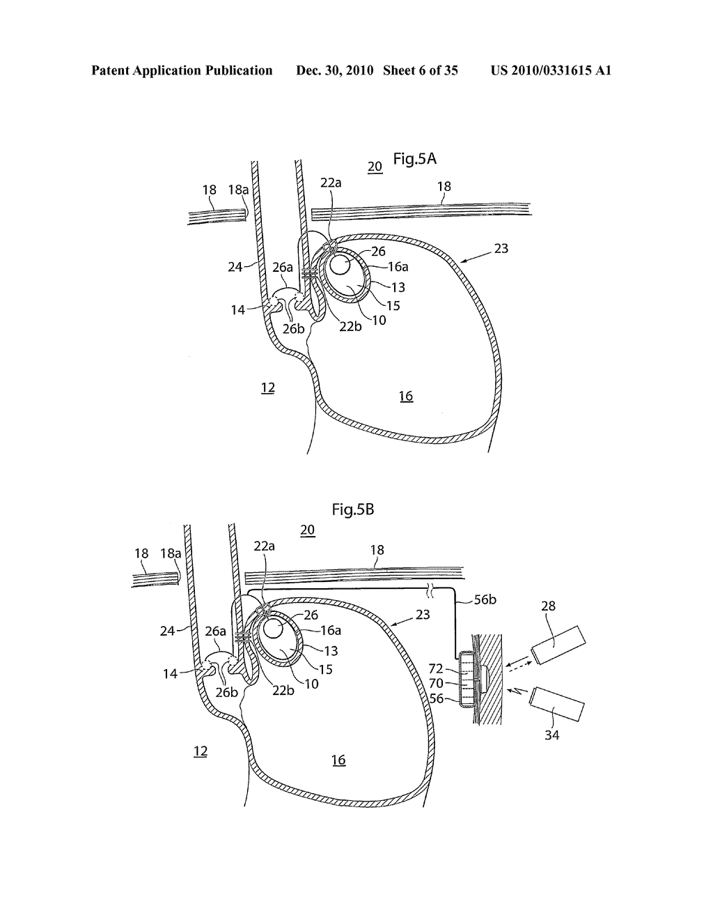 METHOD AND INSTRUMENTS FOR TREATING GERD - diagram, schematic, and image 07