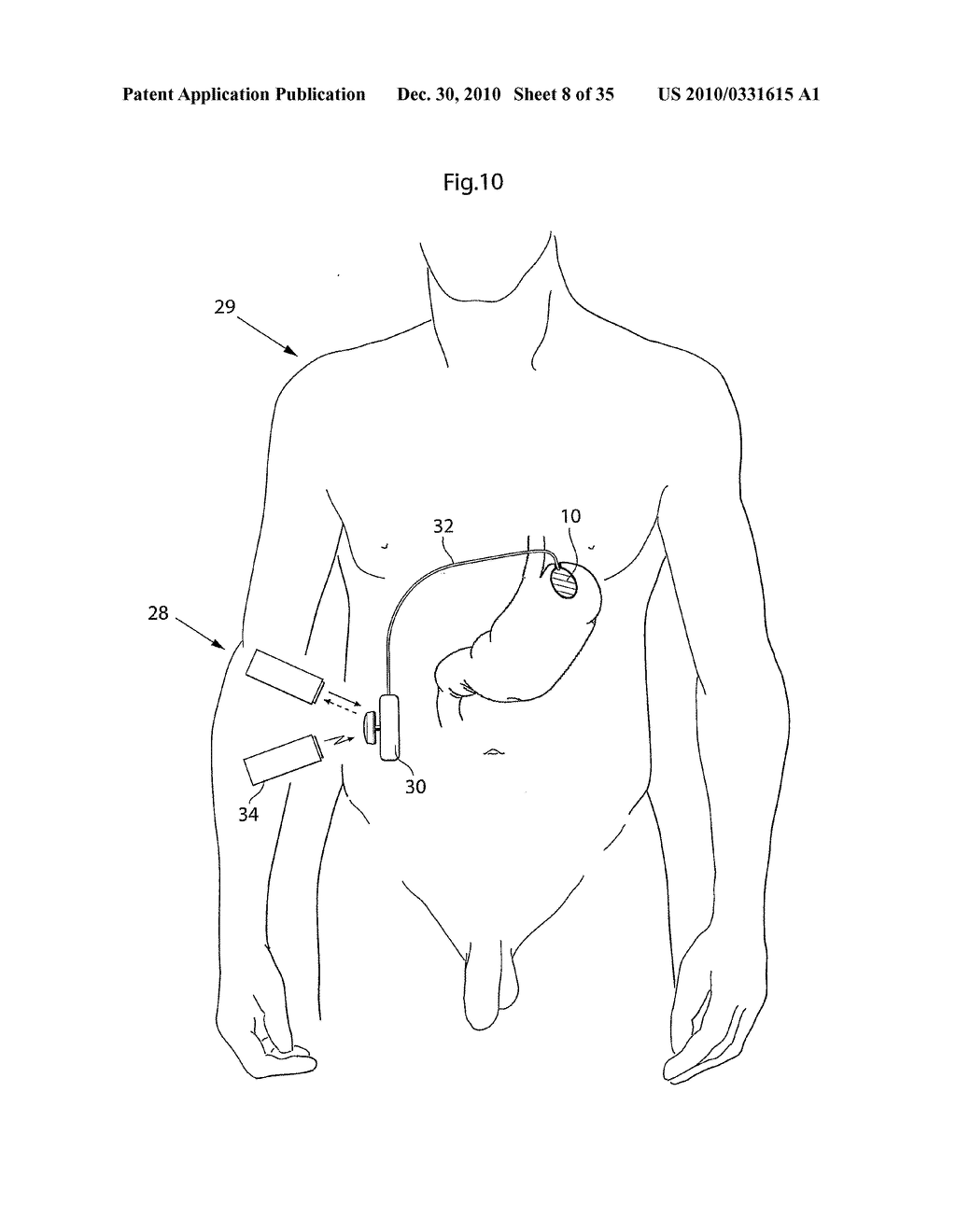 METHOD AND INSTRUMENTS FOR TREATING GERD - diagram, schematic, and image 09