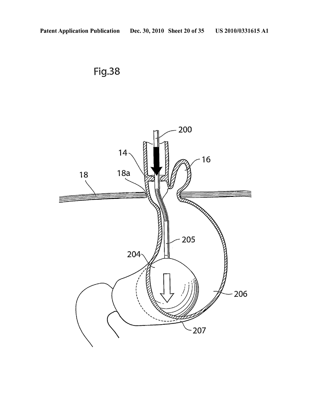 METHOD AND INSTRUMENTS FOR TREATING GERD - diagram, schematic, and image 21