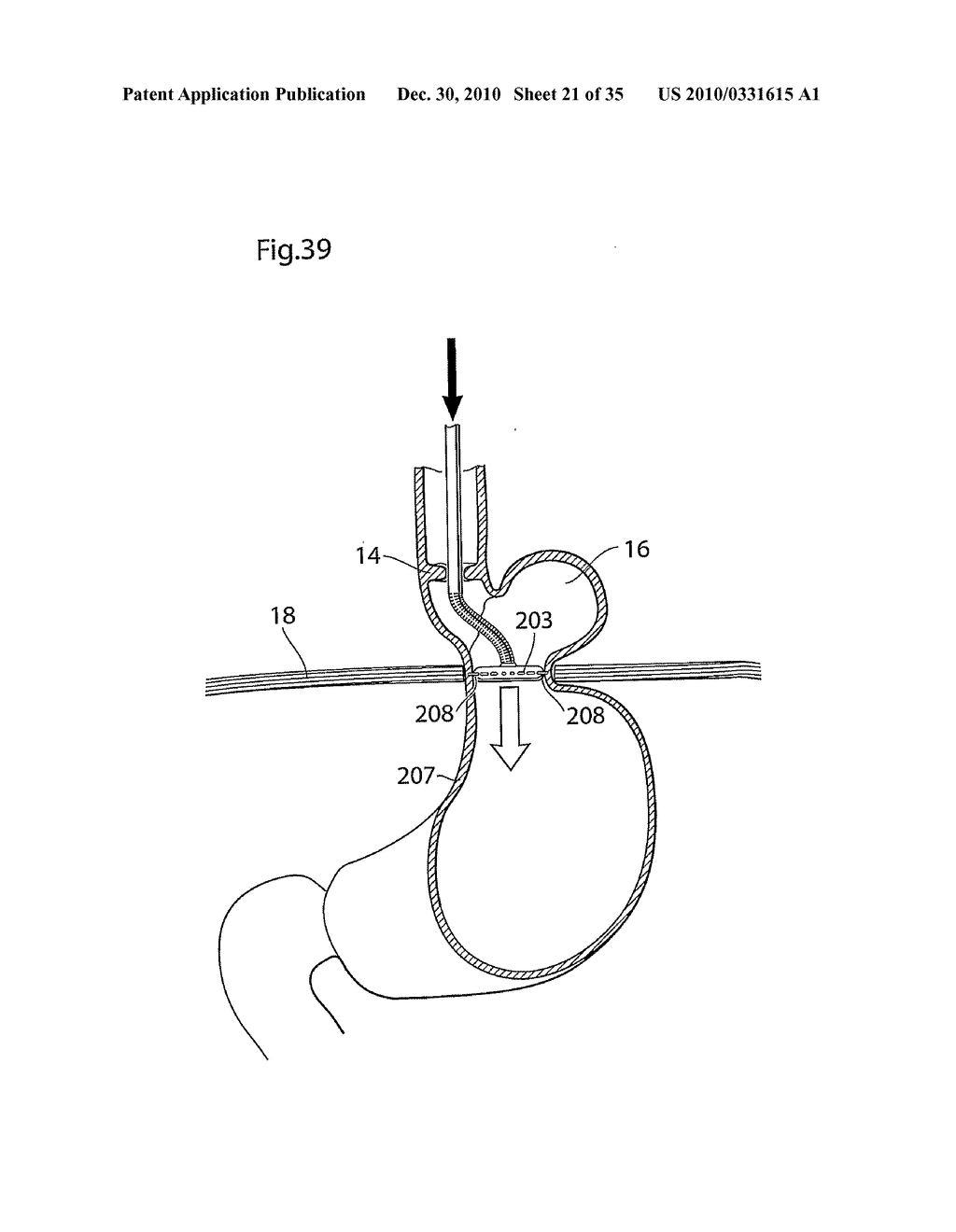 METHOD AND INSTRUMENTS FOR TREATING GERD - diagram, schematic, and image 22