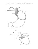 METHOD AND INSTRUMENTS FOR TREATING GERD diagram and image