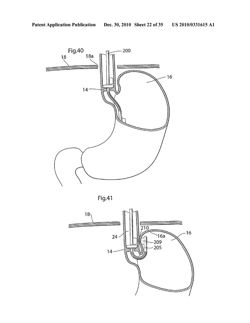 METHOD AND INSTRUMENTS FOR TREATING GERD - diagram, schematic, and image 23