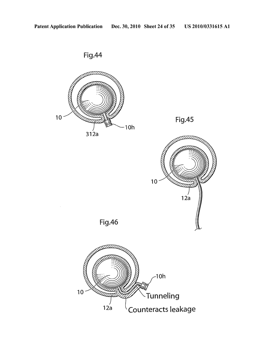 METHOD AND INSTRUMENTS FOR TREATING GERD - diagram, schematic, and image 25