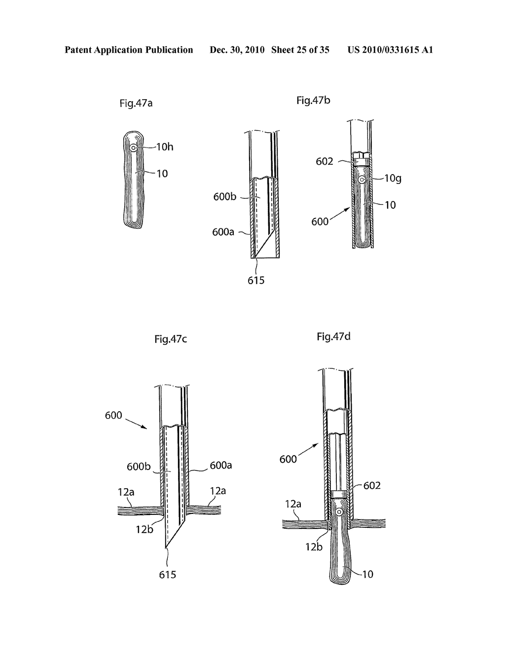 METHOD AND INSTRUMENTS FOR TREATING GERD - diagram, schematic, and image 26