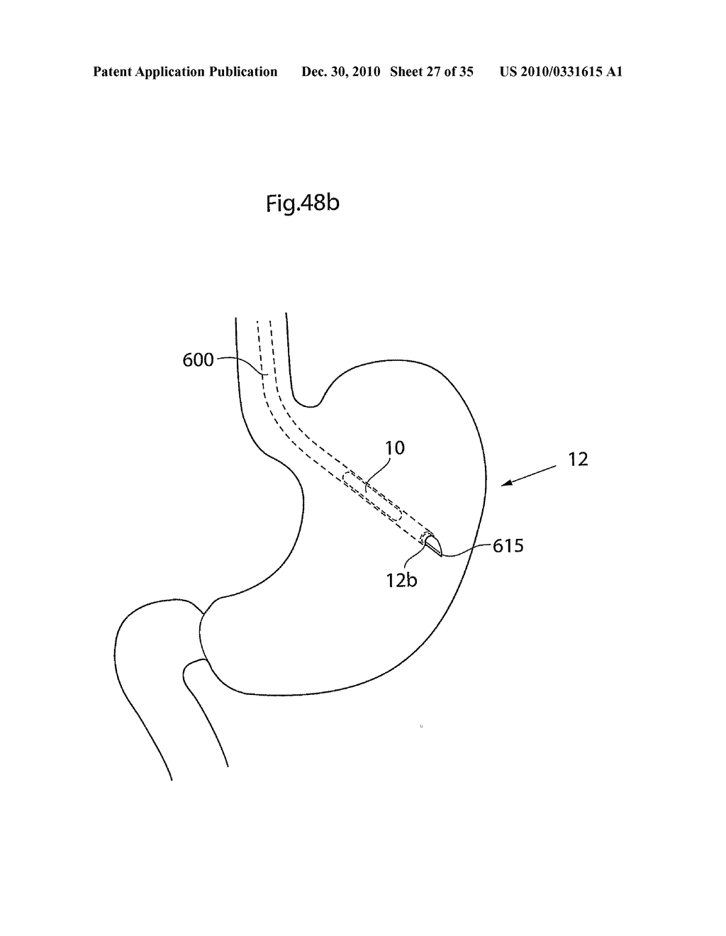 METHOD AND INSTRUMENTS FOR TREATING GERD - diagram, schematic, and image 28