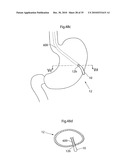 METHOD AND INSTRUMENTS FOR TREATING GERD diagram and image
